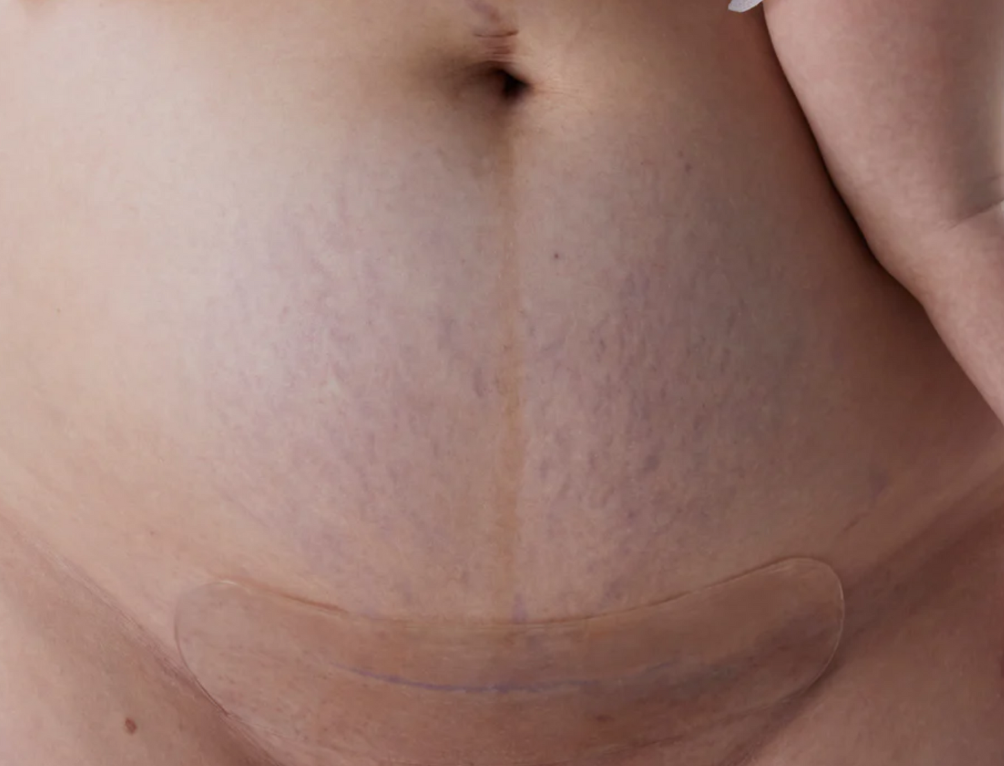 Fæðing með keisaraskurði- pakki frá Bare Mum