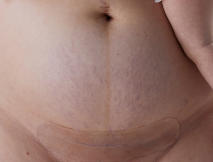 Fæðing með keisaraskurði- pakki frá Bare Mum